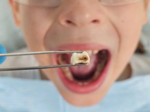 Best Emergency Wisdom Teeth Removal in South Hill, NY